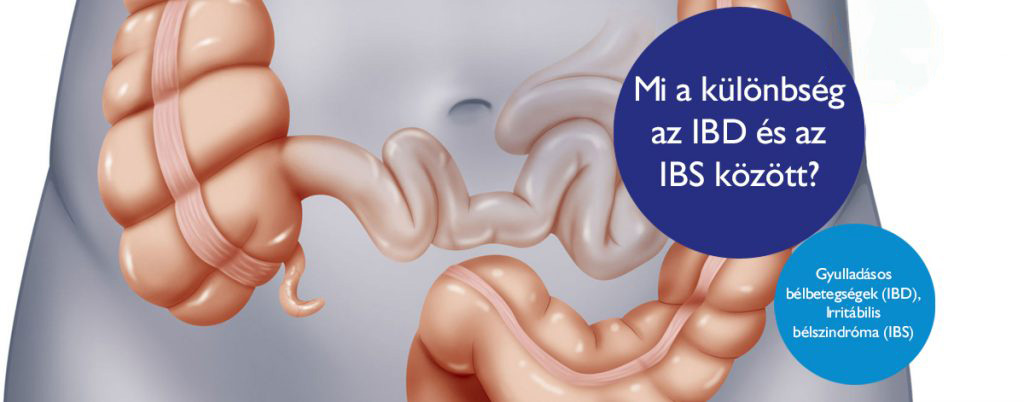 ibs-ibd-kulonbseg