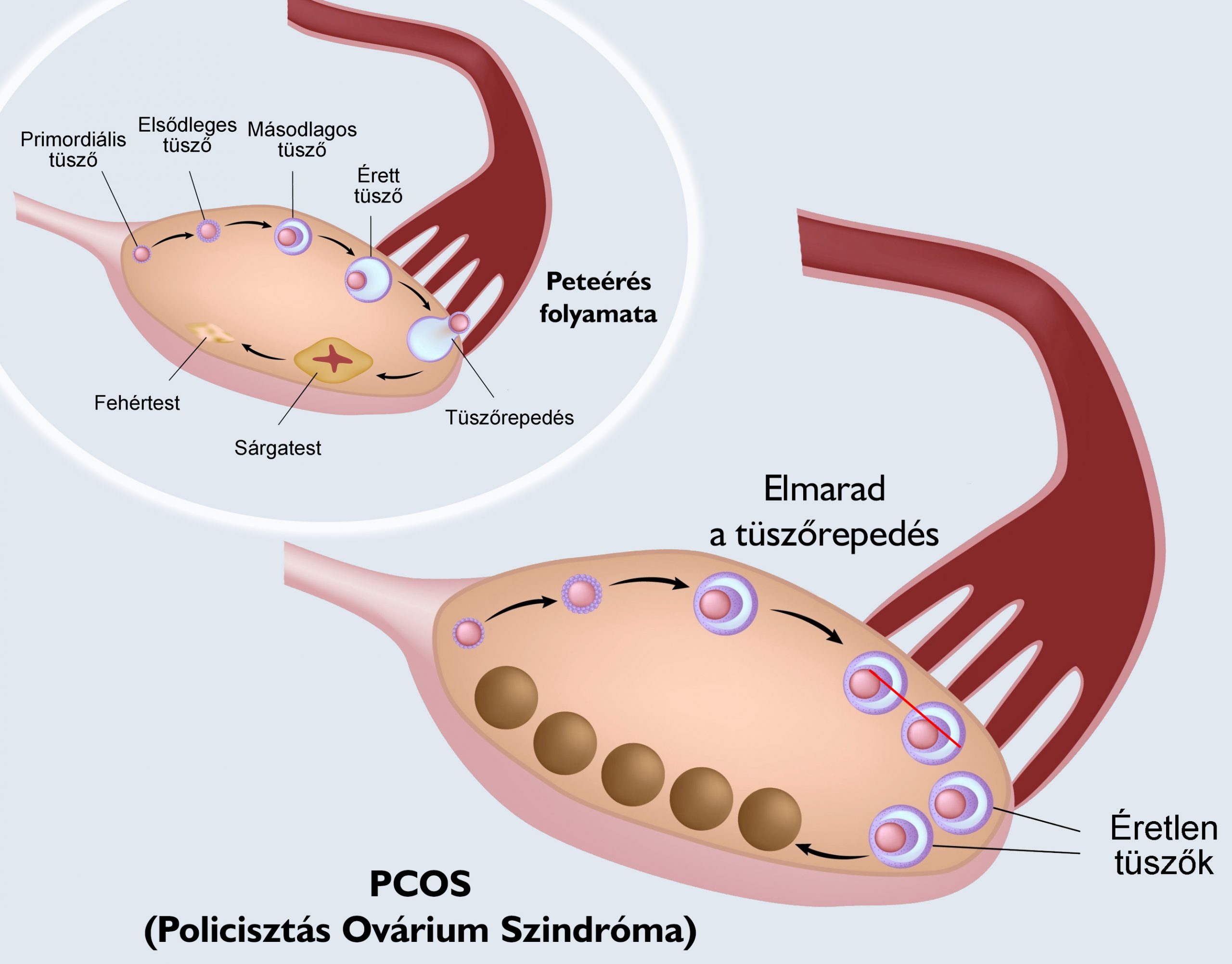 PCOS PCOS