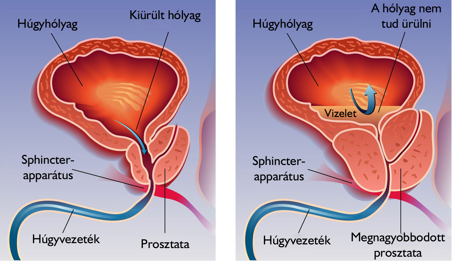 Prosztatamegnagyobbodás Prosztatamegnagyobbodás