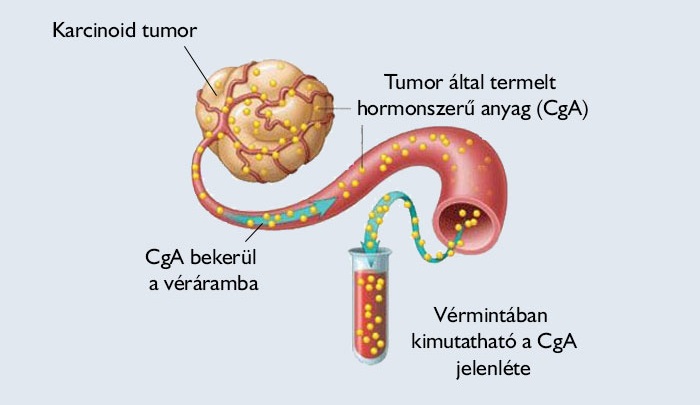 karcinoid tumor karcinoid tumor