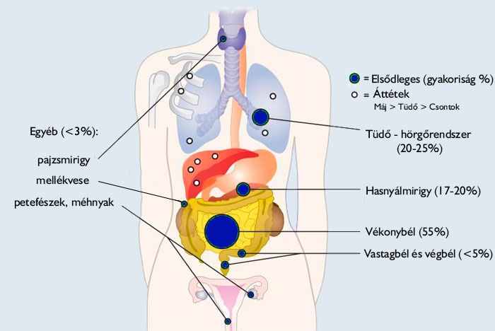 neuroendokrin_daganatok_elhelyezkedese neuroendokrin daganatok elhelyezkedése
