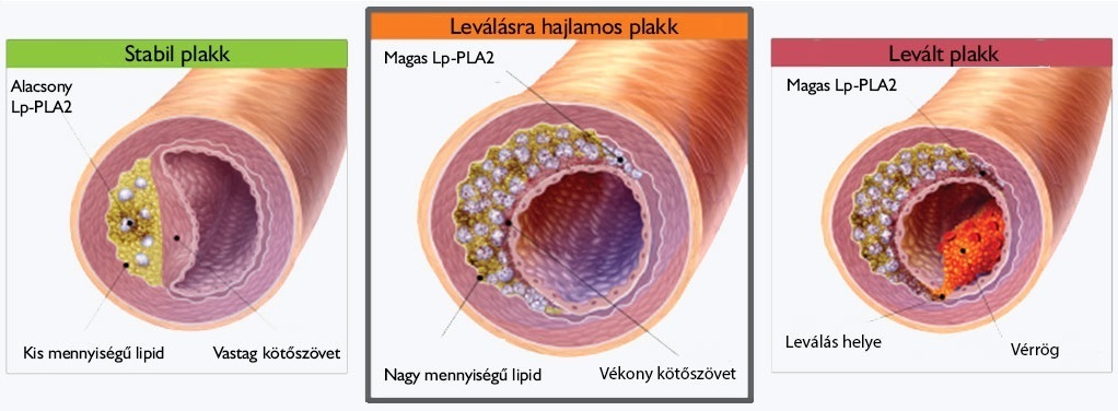 Az érfalon kialakult plakk leválásának folyamata Az érfalon kialakult plakk leválásának folyamata