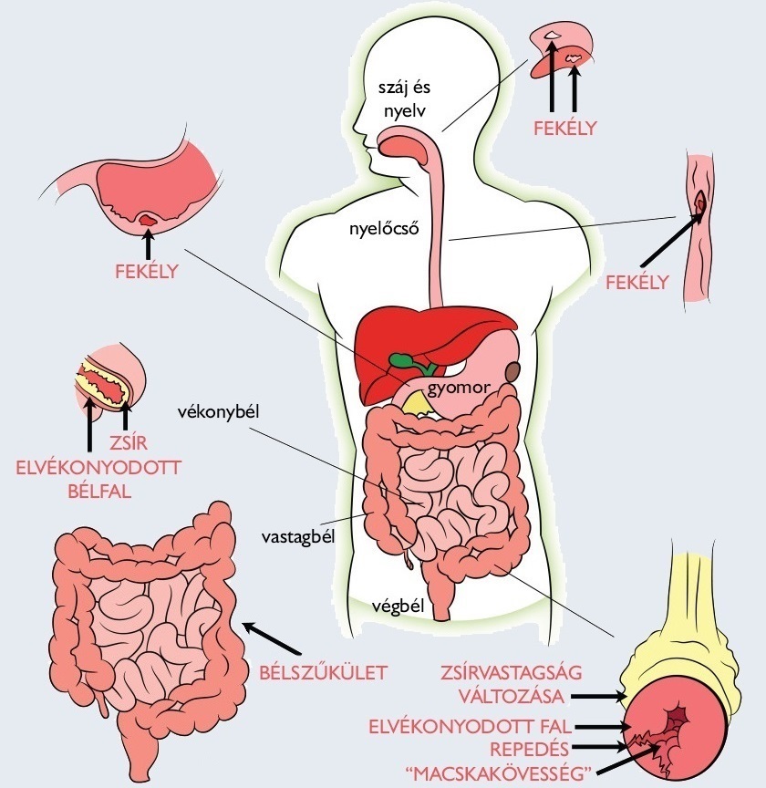Crohn-betegseg Crohn-betegseg