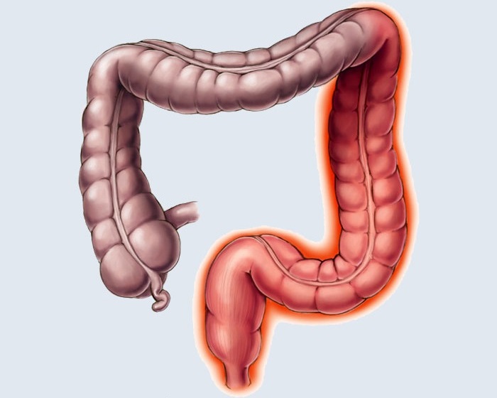 Colitis ulcerosa Colitis ulcerosa