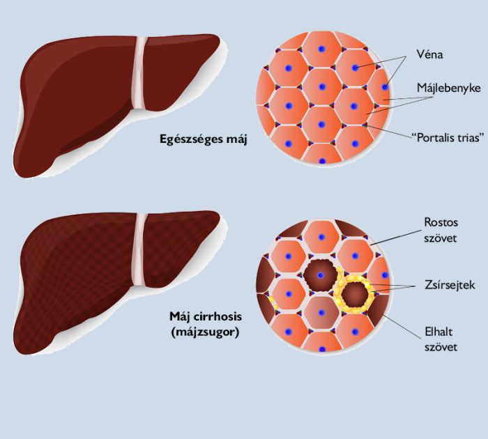 gpt-majzsugor-majcirrhosis-majfunkcio-labor-medicare-laborvizsgalat májzsugor