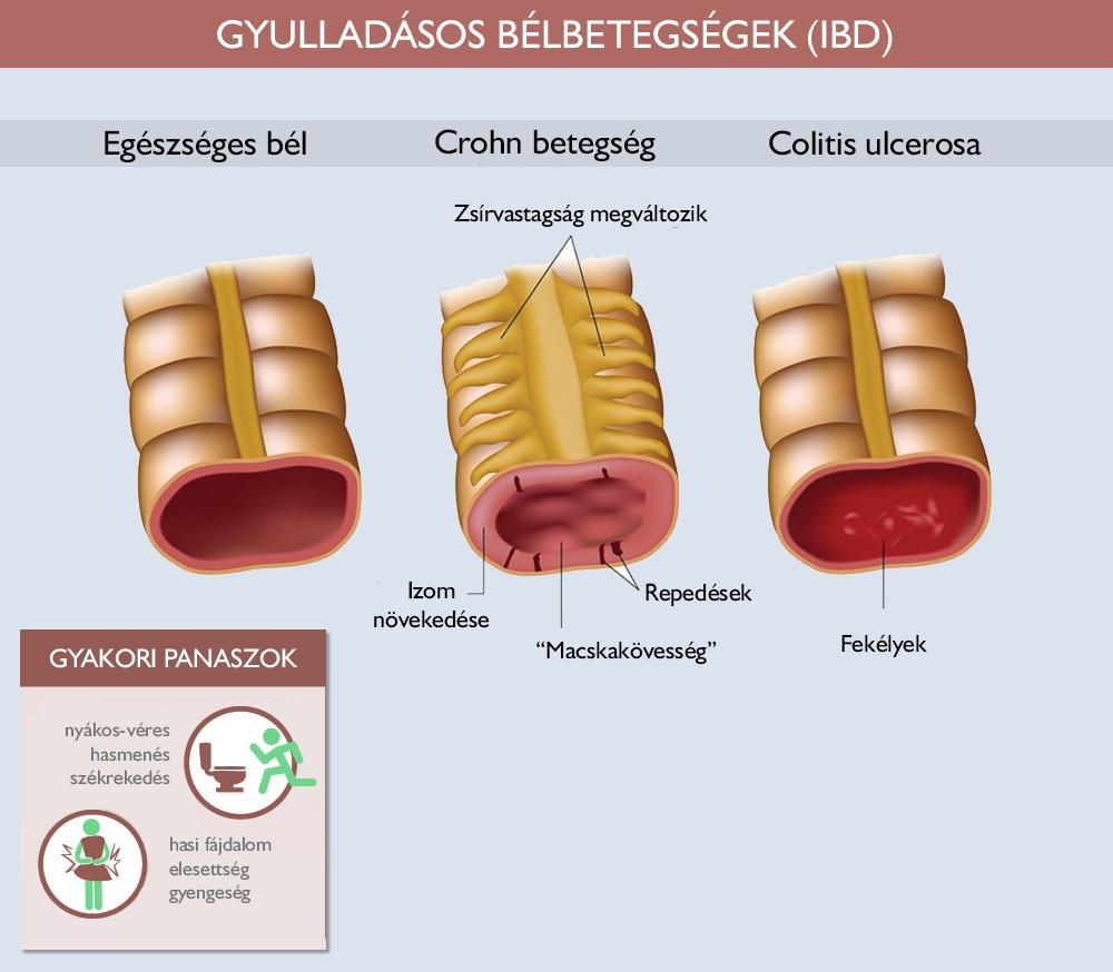 Gyulladásos bélbetegségek IBD Gyulladásos bélbetegségek IBD